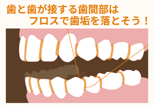 歯と歯が接する歯間部はフロスで歯垢を落とそう！